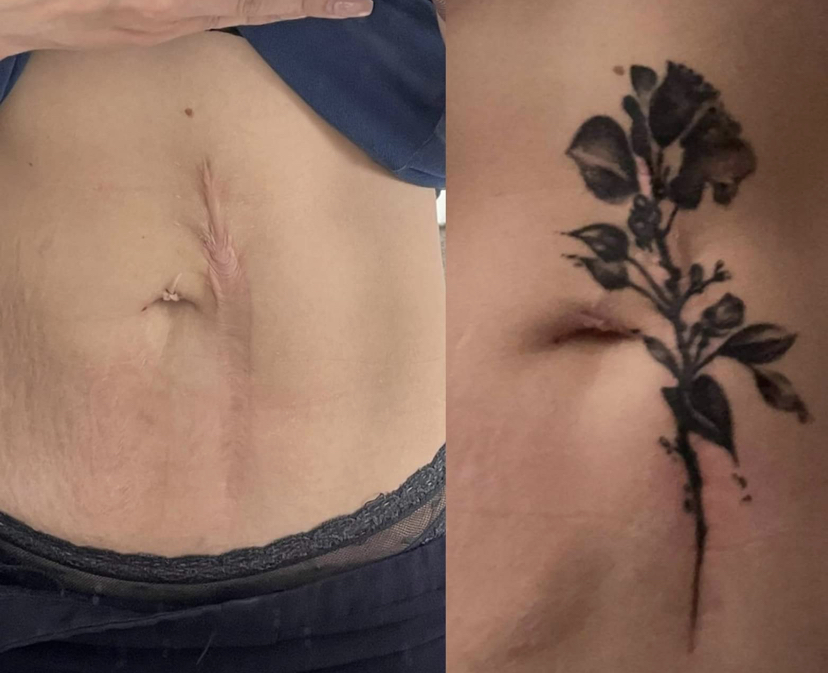 C Section Scar Tattoos